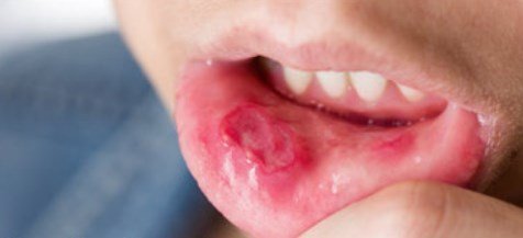 infected lip piercing